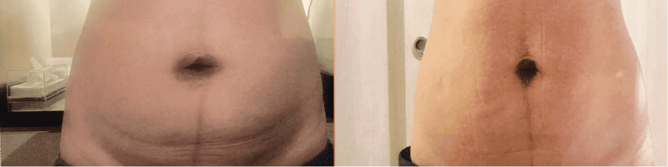 S liminal abdominal area reduction before and after treatment, showcasing improved skin tightness.